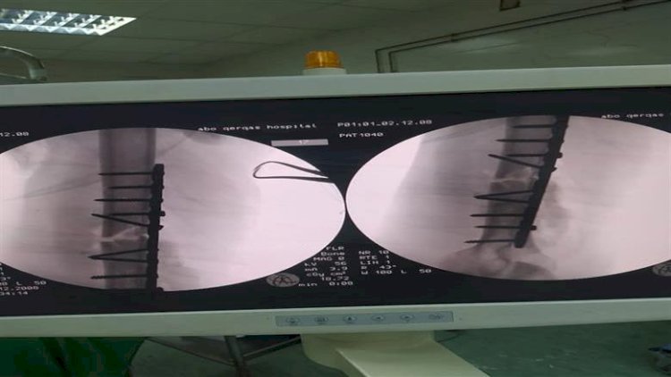 فريق طبي ينجح في إجراء دقيقة لمريض يعاني من كسر معقد بالذراع في المنيا