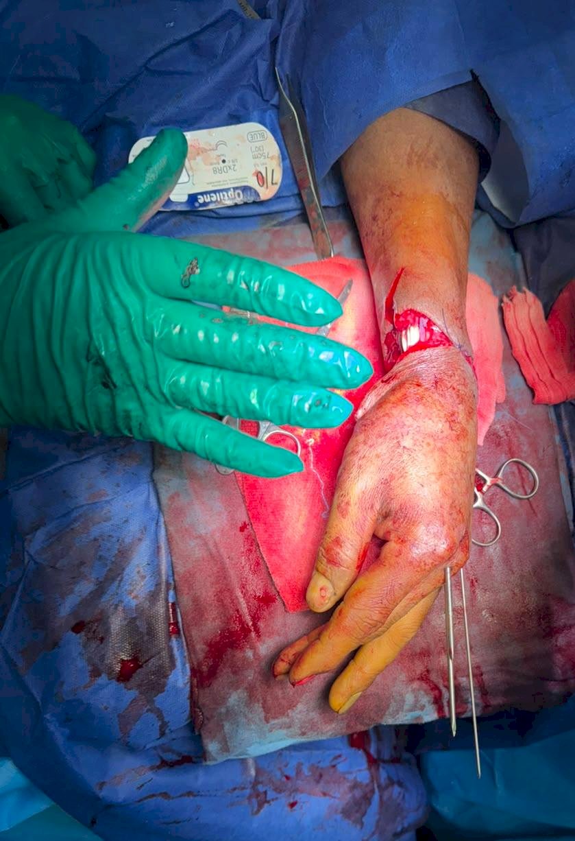 فريق جراحة التجميل بعد 6 ساعات .. أطباء جامعة أسوان يعيدون يدًا مبتورة